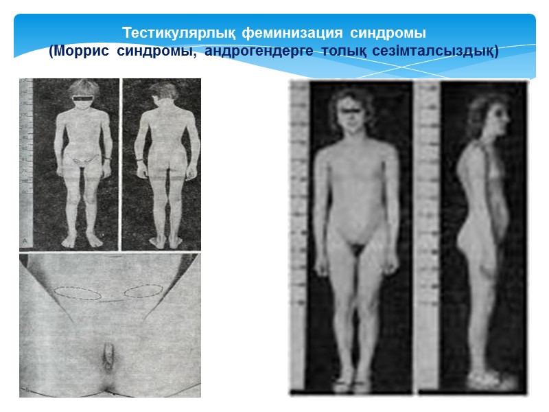 Тестикулярлық феминизация синдромы  (Моррис синдромы, андрогендерге толық сезімталсыздық)